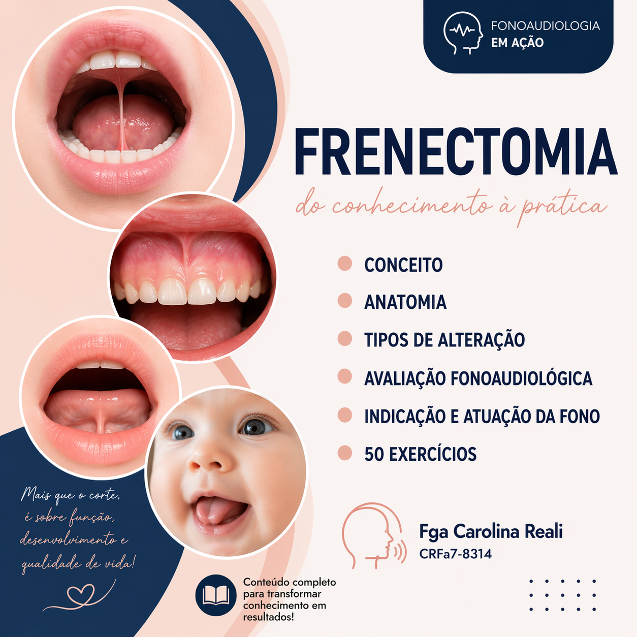 Frenectomia — Guia Fonoaudiológico